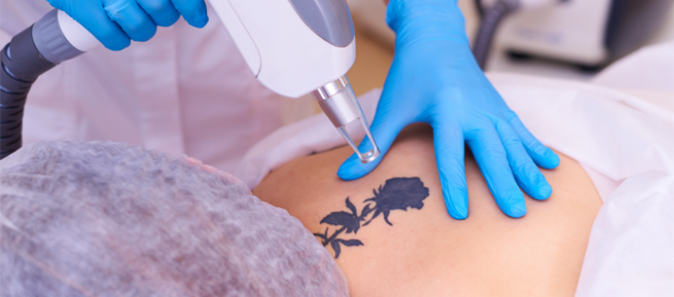 Αφαίρεση Τατουάζ