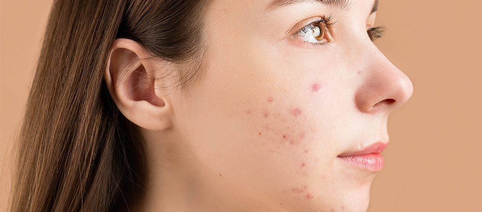 Θεραπεία Ακμής