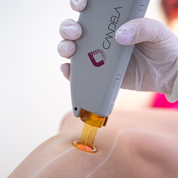 Candela Laser Αλεξανδρίτη apotrixosi dermaesthete clinic pireas