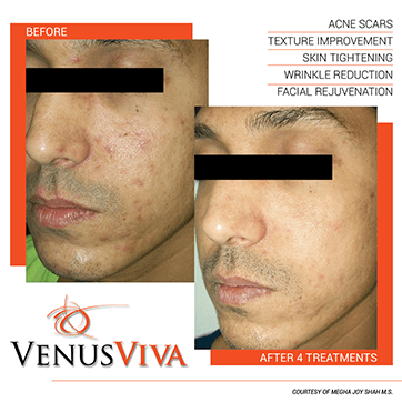 Nanofractional RF Venus Viva dermaesthete clinic δερματολόγος πειραιάς