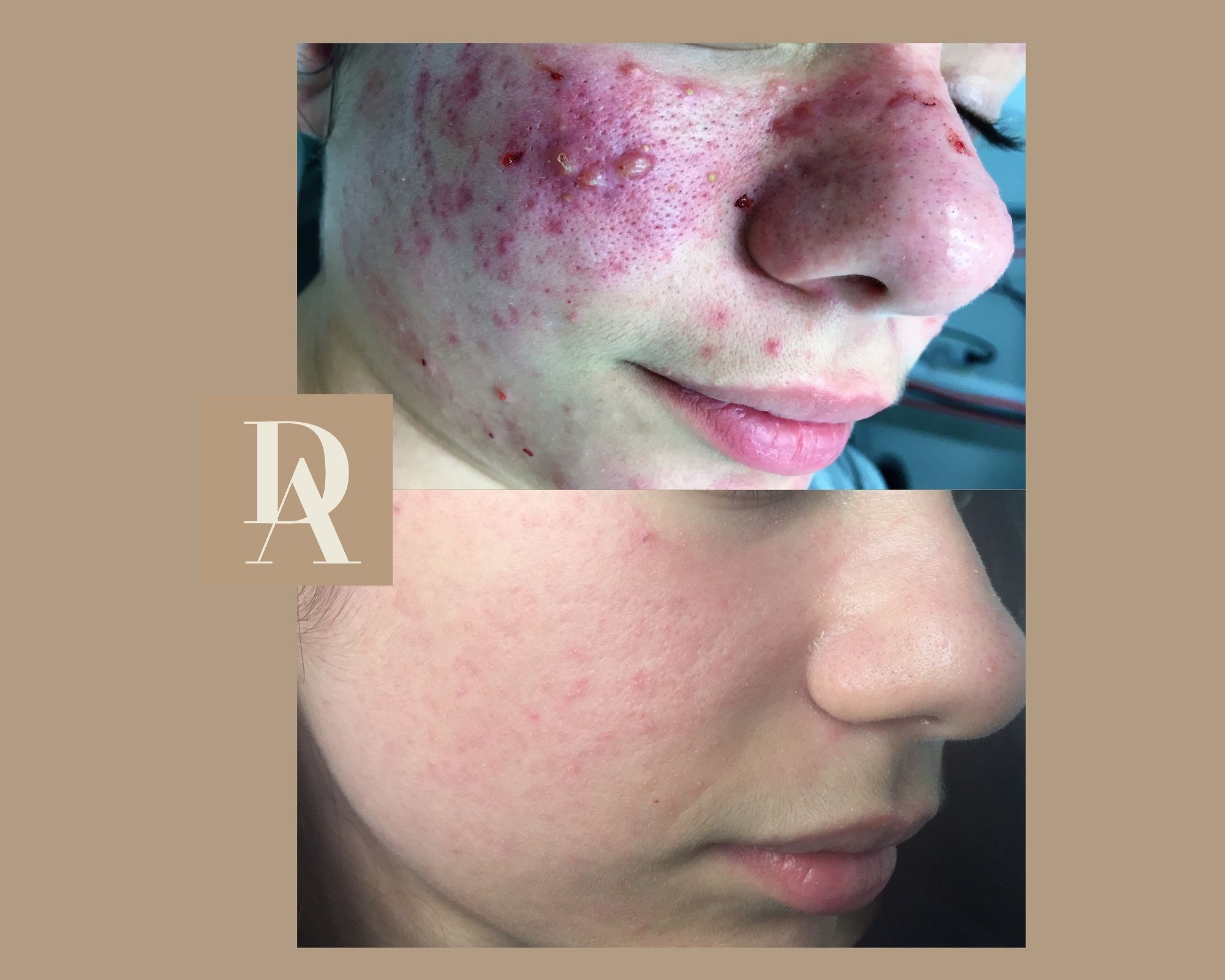 Θεραπεία Ακμής DermAesthete Clinic