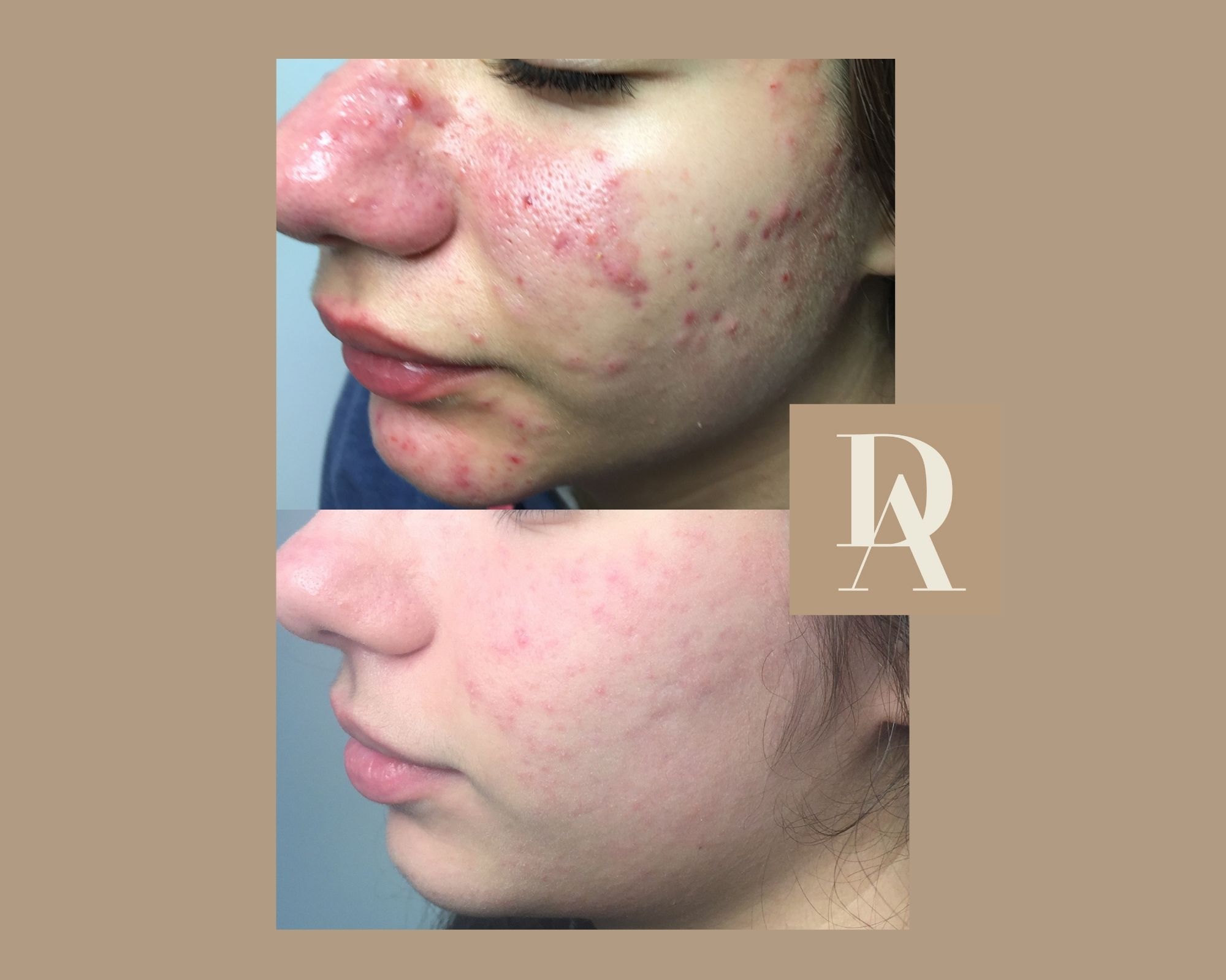 Θεραπεία Ακμής DermAesthete Clinic