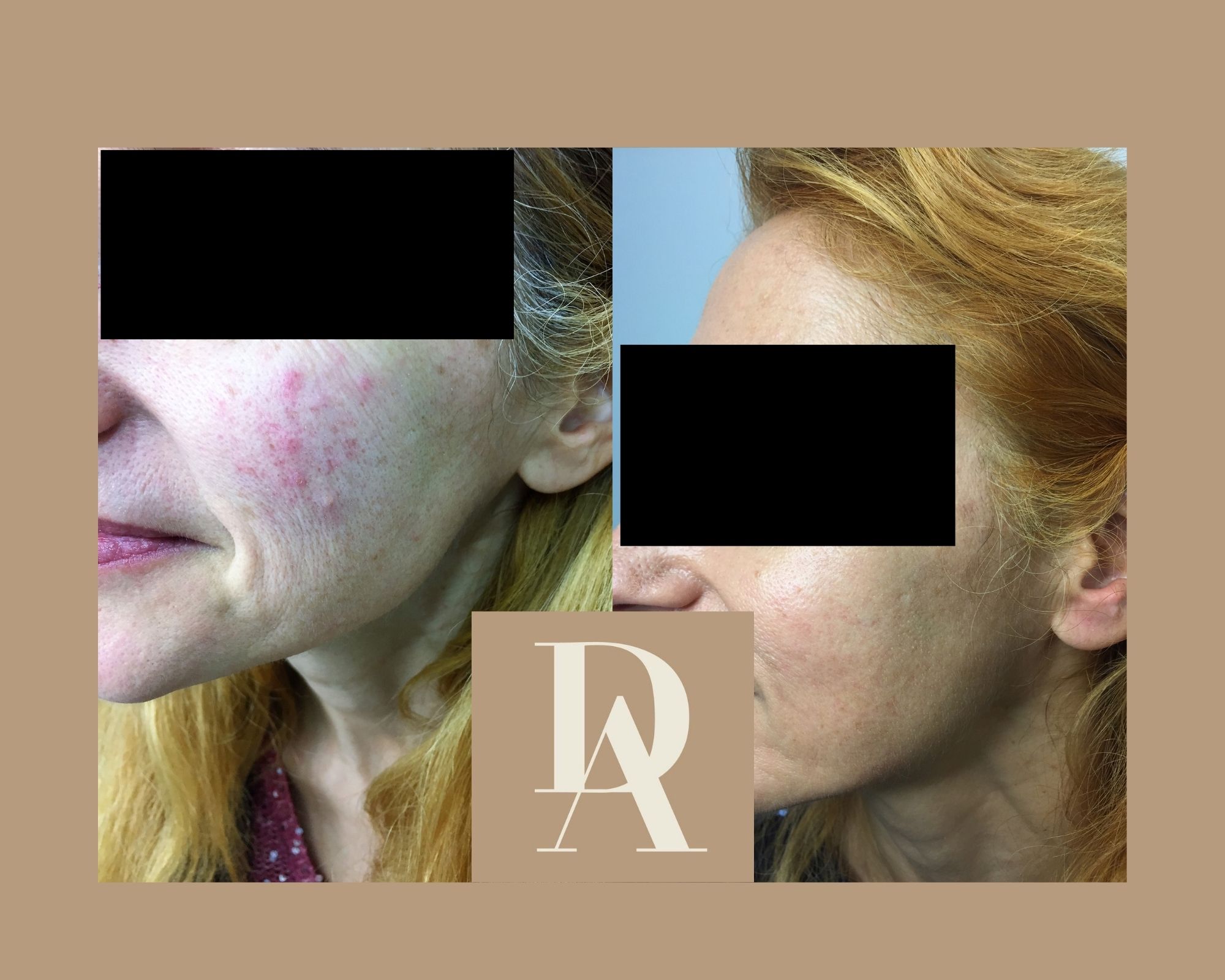 Θεραπεία Ακμής DermAesthete Clinic