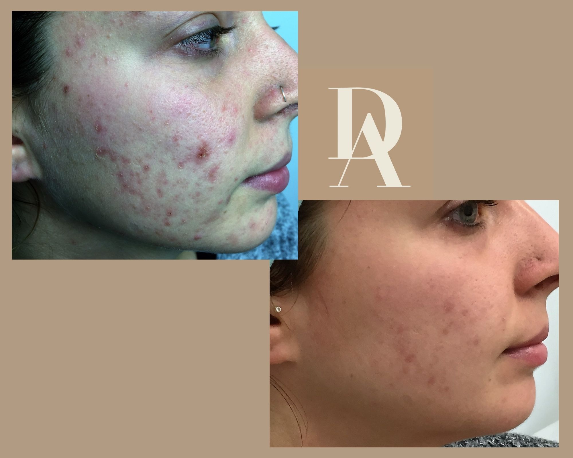 Θεραπεία Ακμής DermAesthete Clinic