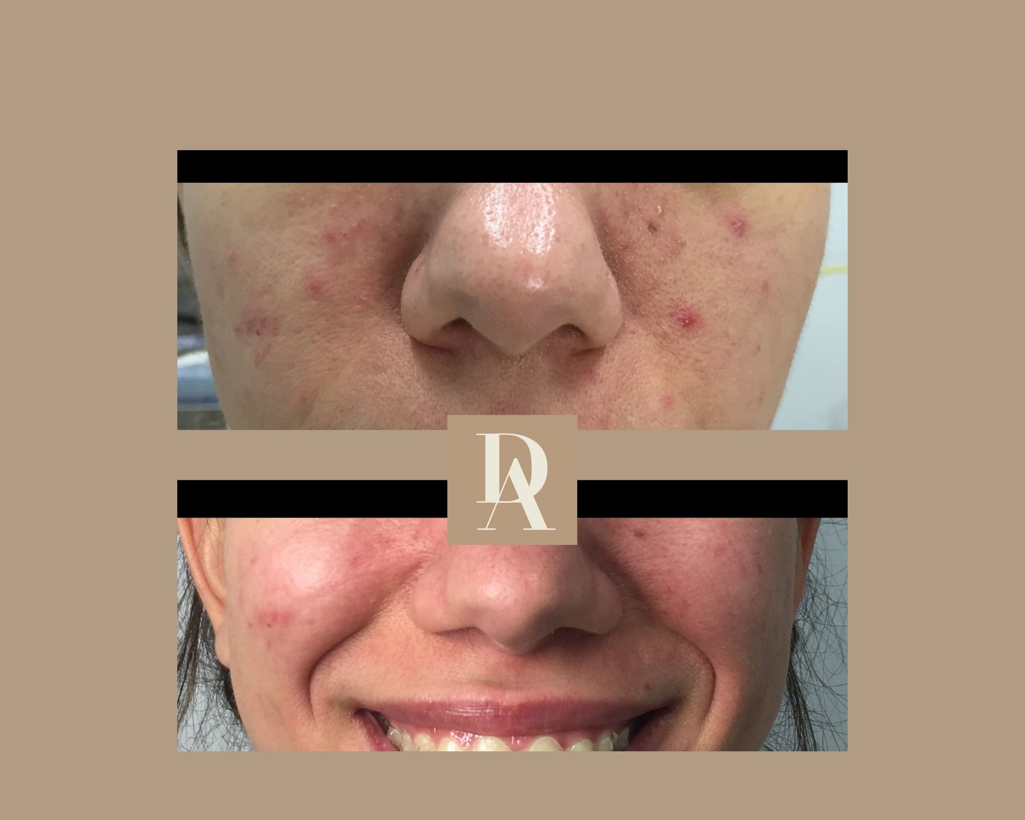 Θεραπεία Ακμής DermAesthete Clinic