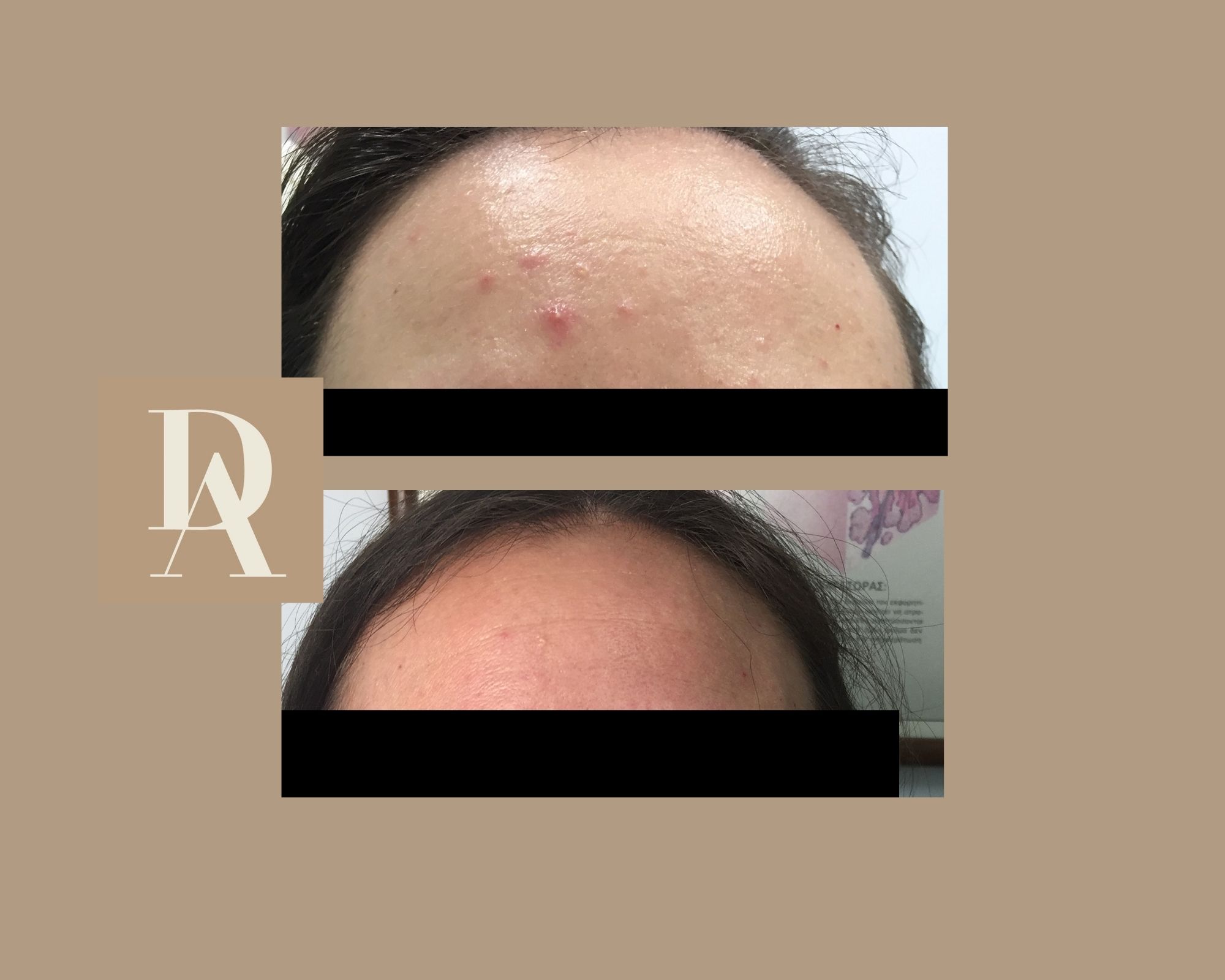 Θεραπεία Ακμής DermAesthete Clinic