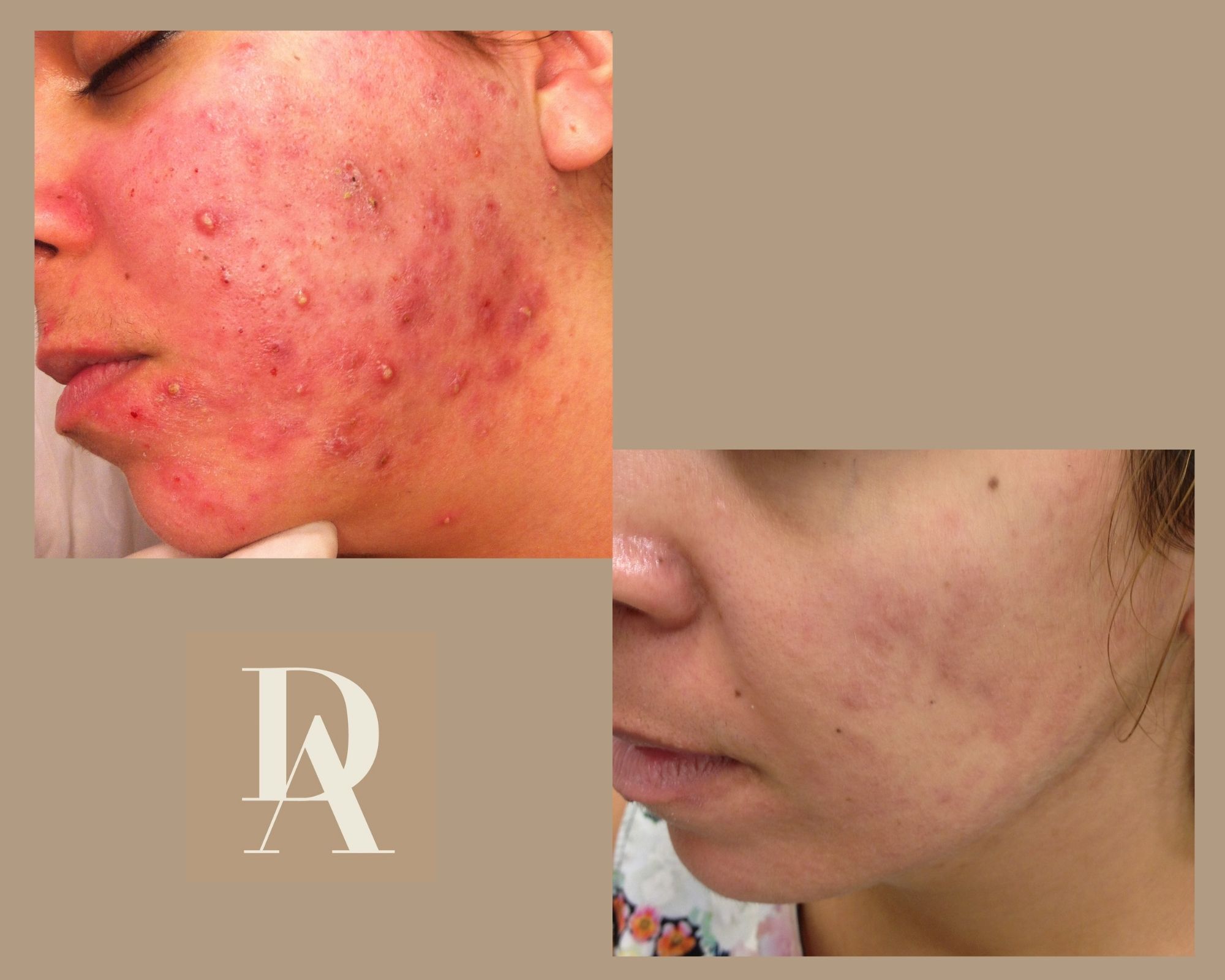 Θεραπεία Ακμής DermAesthete Clinic