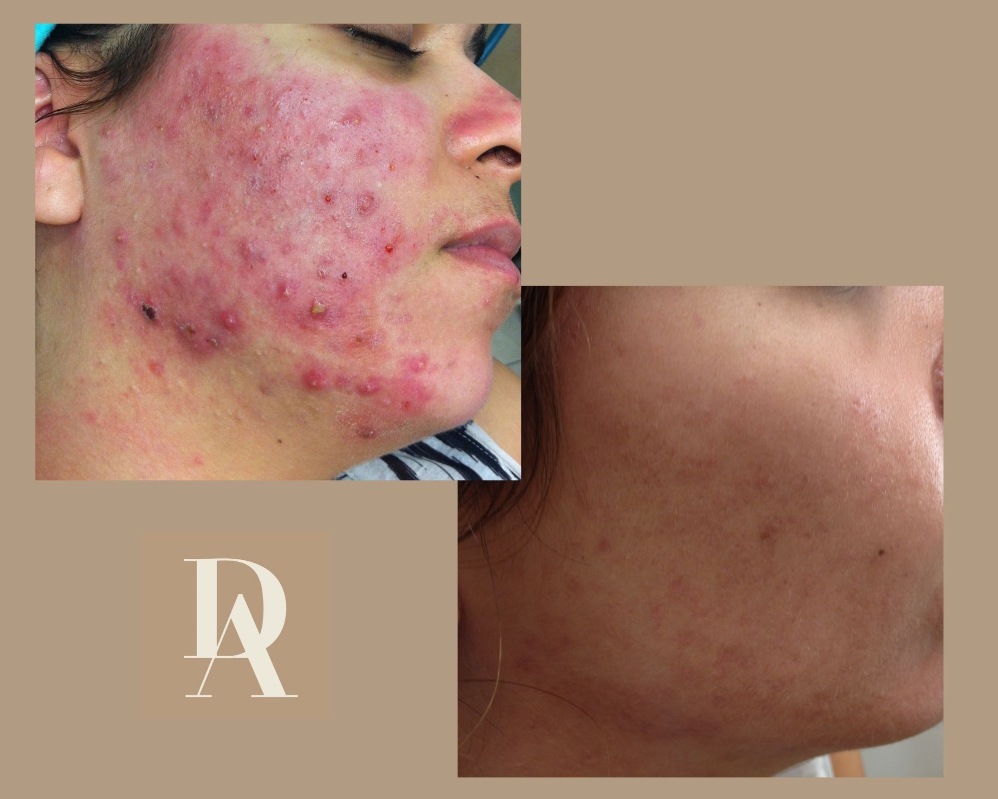 Θεραπεία Ακμής DermAesthete Clinic