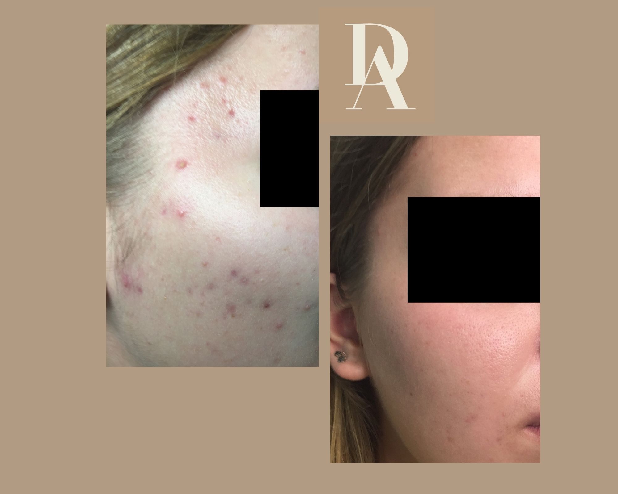 Θεραπεία Ακμής DermAesthete Clinic