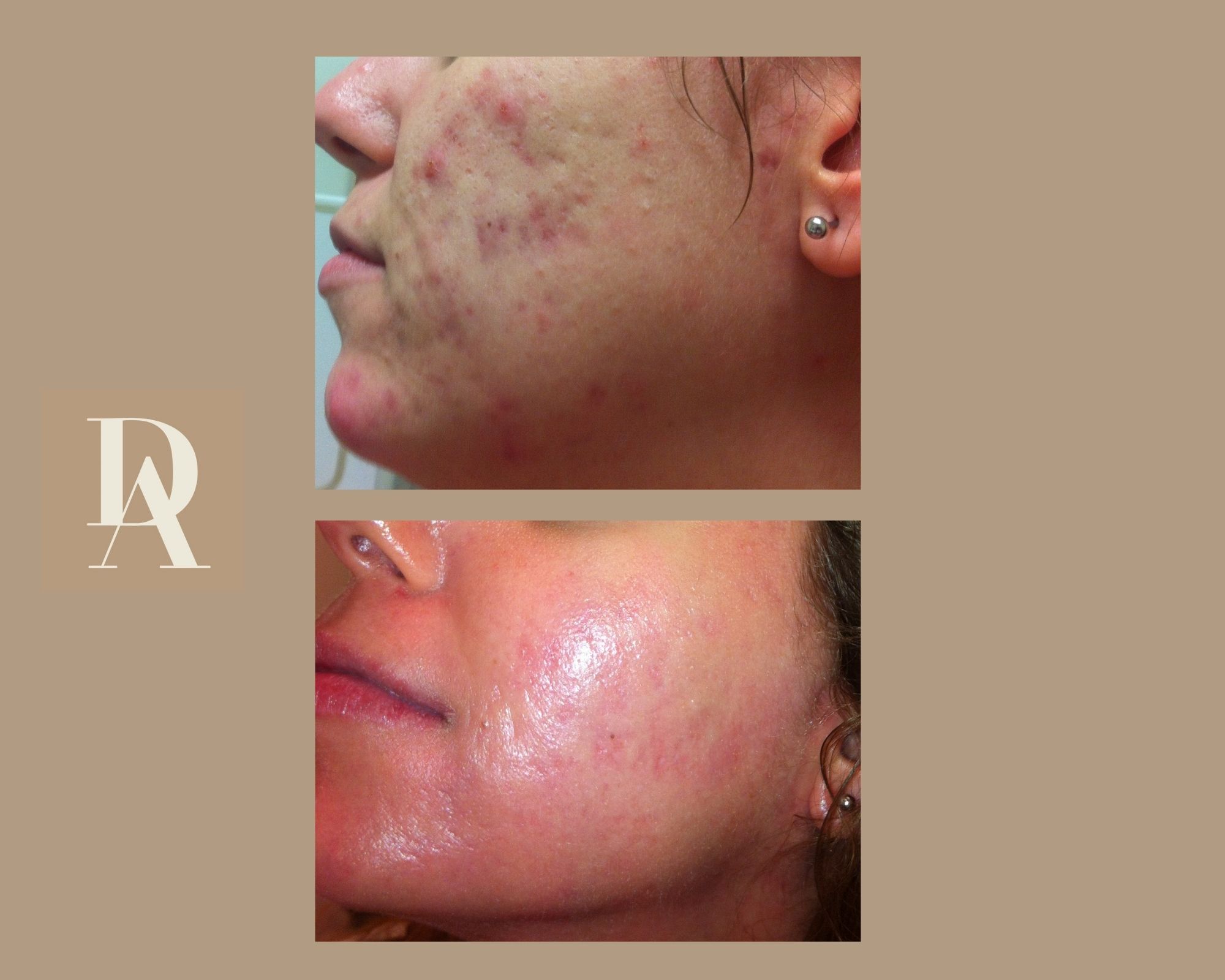 Θεραπεία Ακμής DermAesthete Clinic