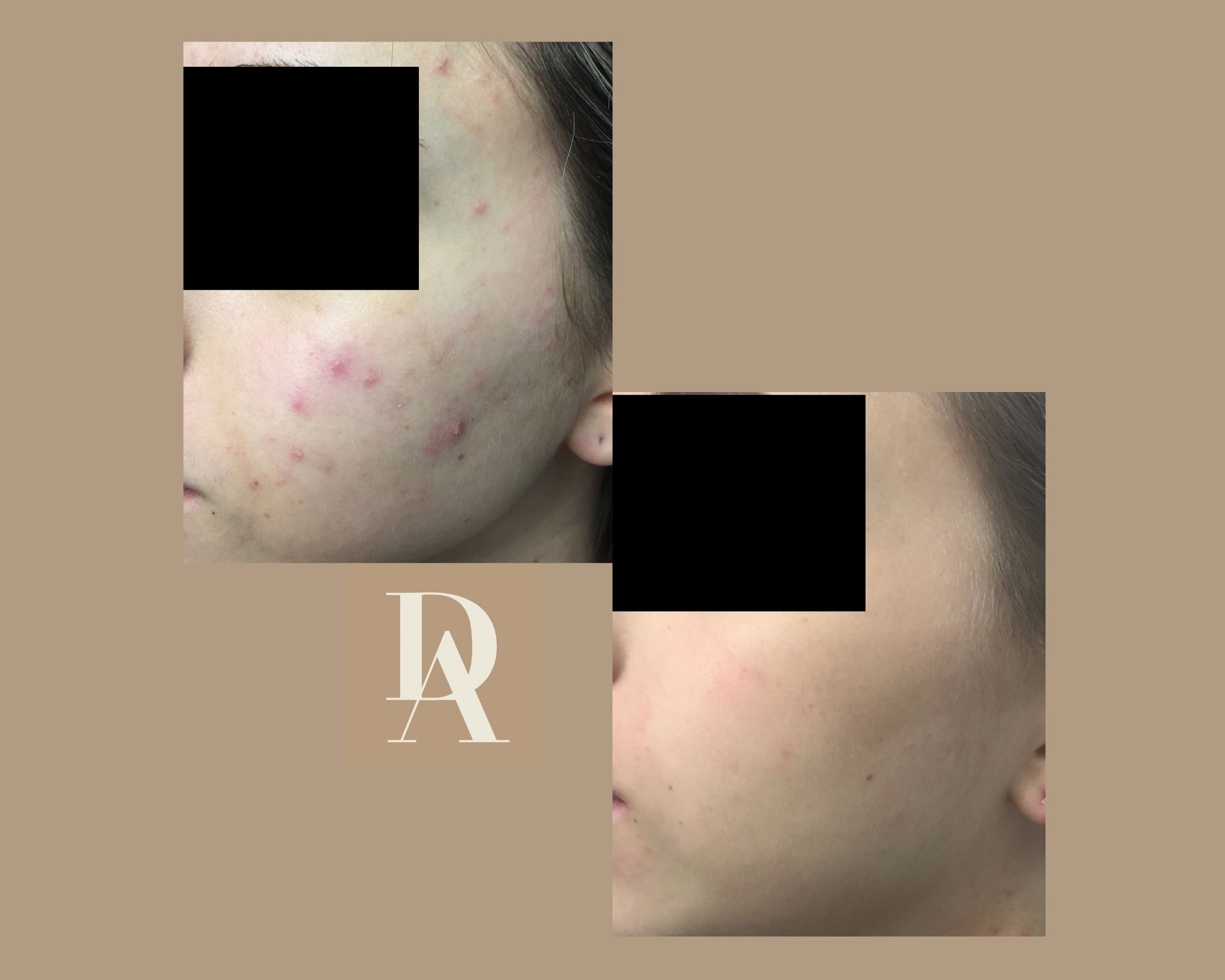 Θεραπεία Ακμής DermAesthete Clinic