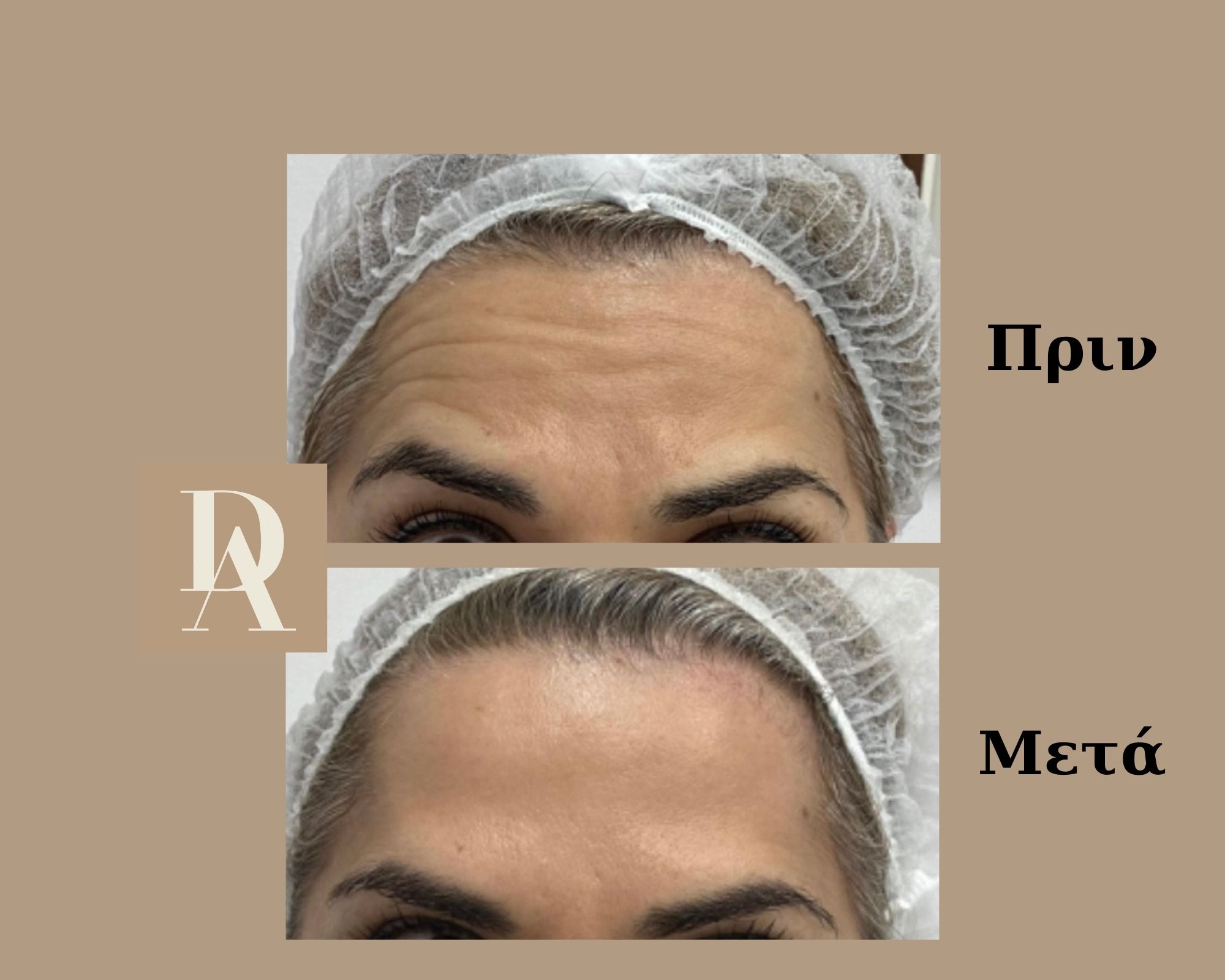 Θεραπεία με Βοτουλινική Τοξίνη