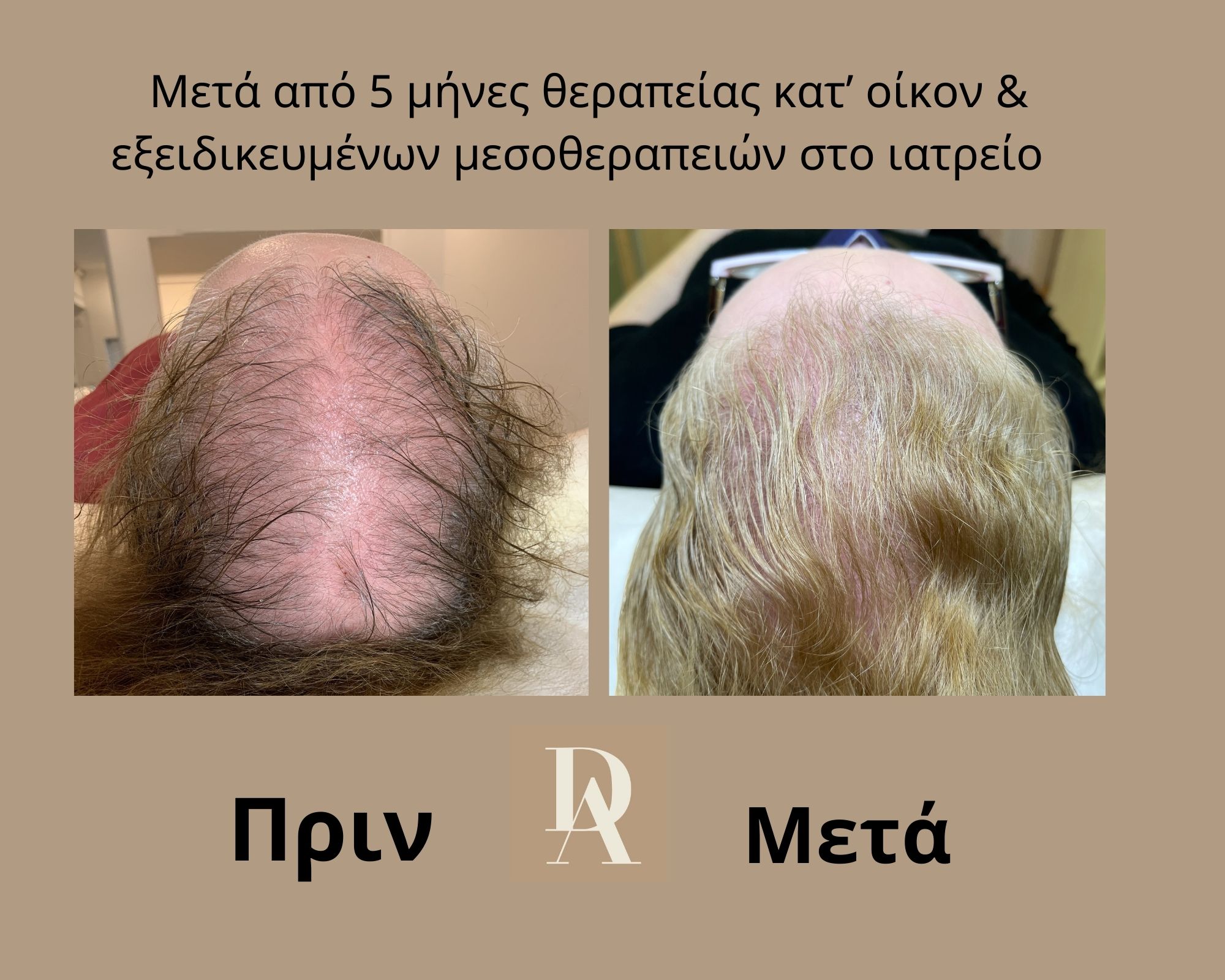 Θεραπεία Τριχόπτωσης