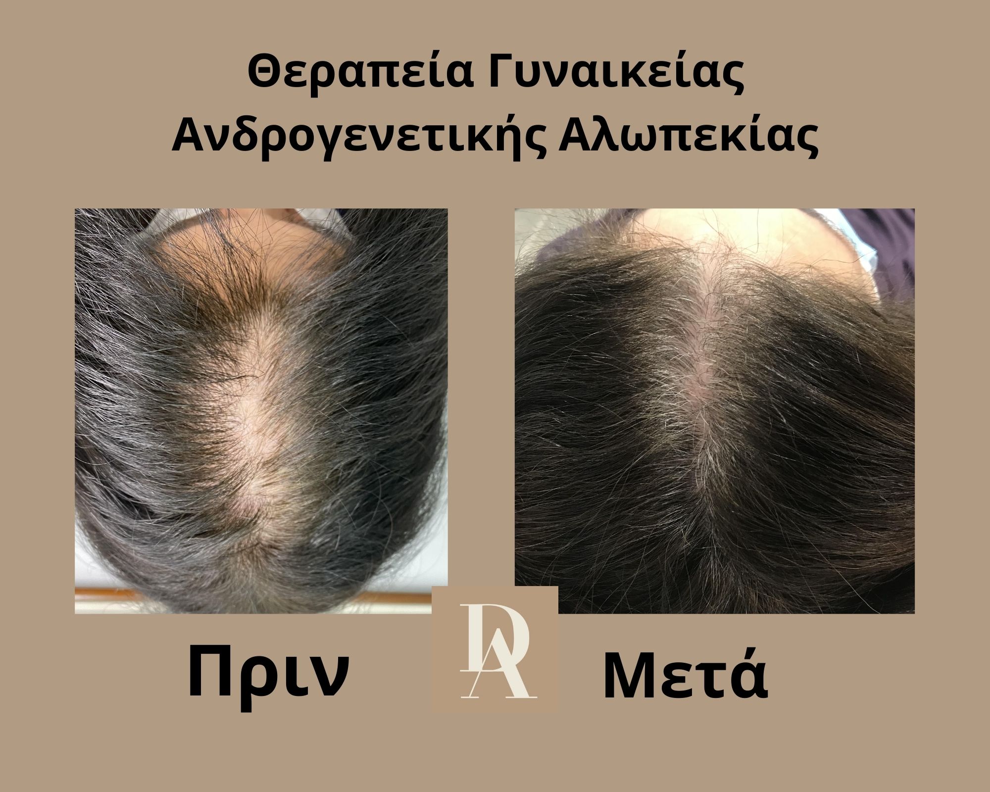 Θεραπεία Τριχόπτωσης