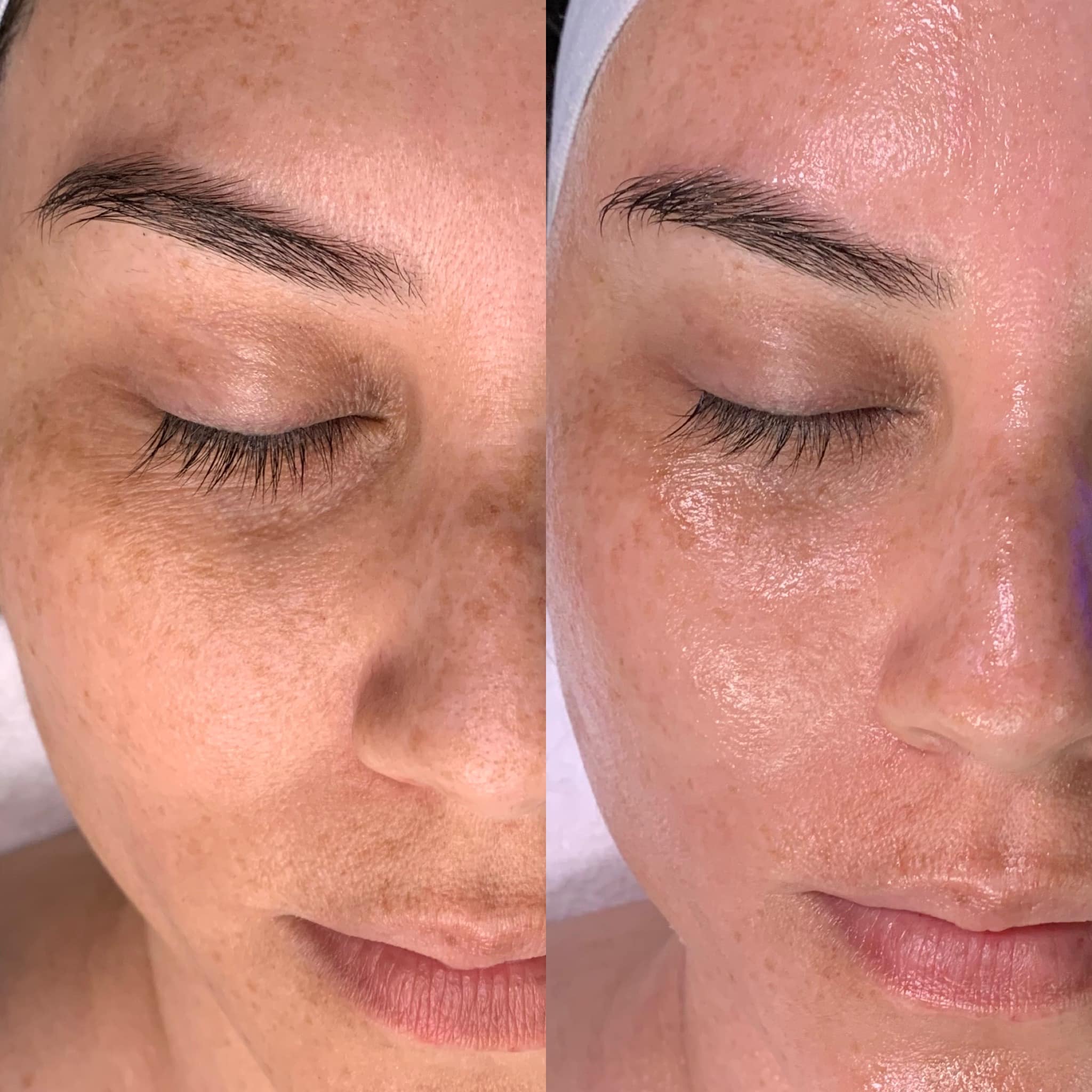 hydrafacial 2
