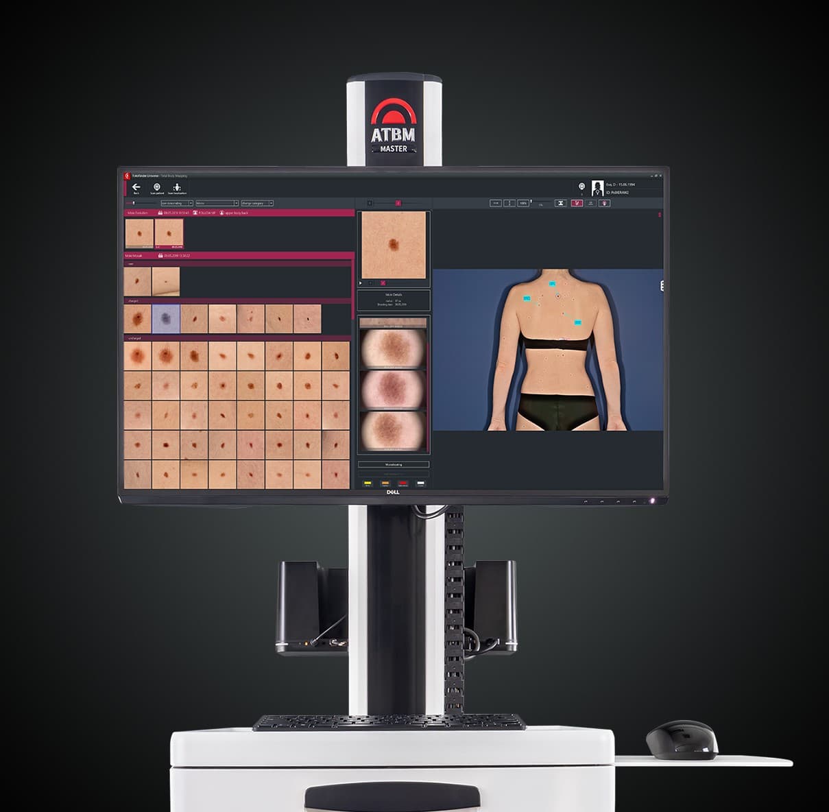 Ολόσωμη Ψηφιακή Χαρτογράφηση FotoFinder ATBM MAster