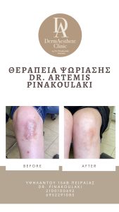 θεραπεία ψωρίασης από τη Δερματολόγο dr. Artemis Pinakoulaki