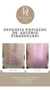 θεραπεία ψωρίασης από τη Δερματολόγο dr. Artemis Pinakoulaki
