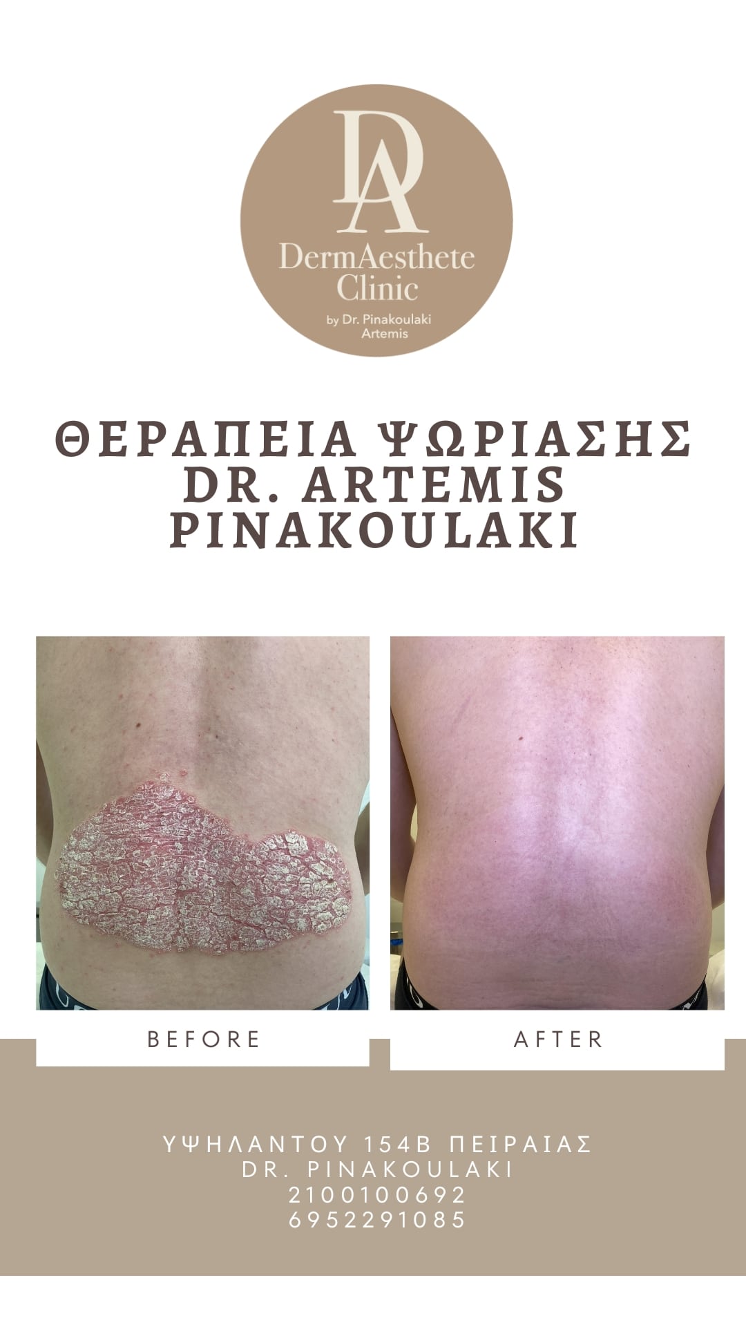 Θεραπεία Ψωρίασης